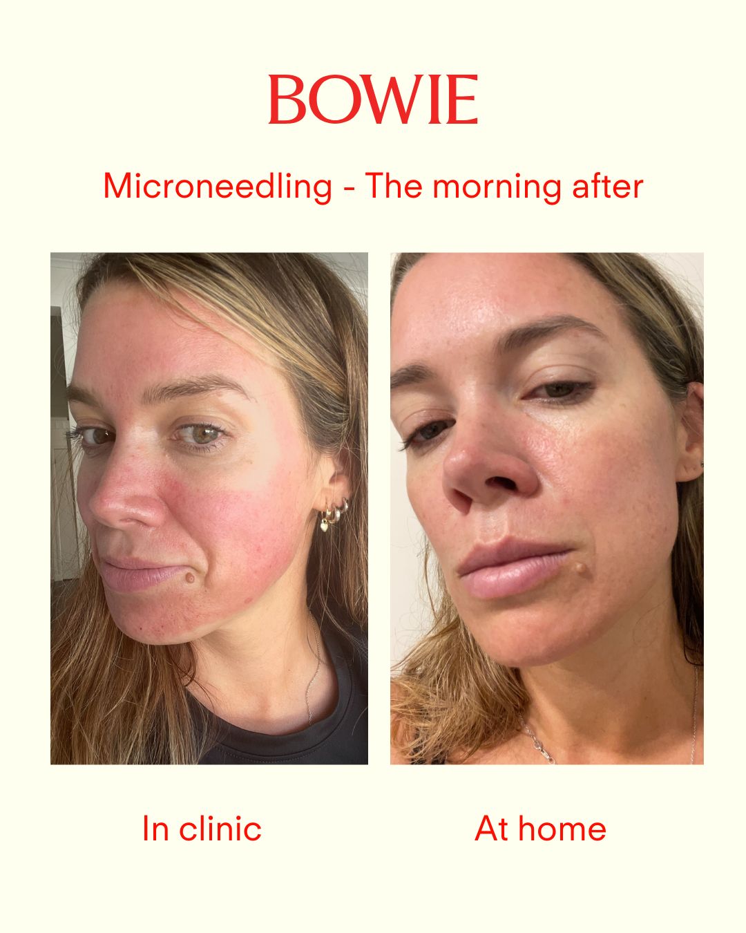 Microneedling: In clinic vs. at home. Here's what you need to know.