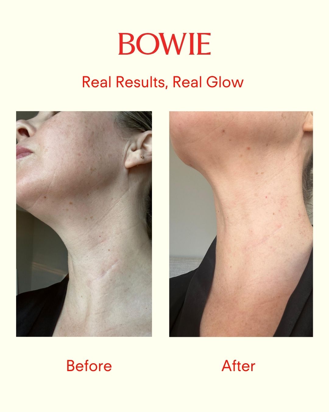 A Personal Story – How Microneedling Changed My Neck (And My Confidence)