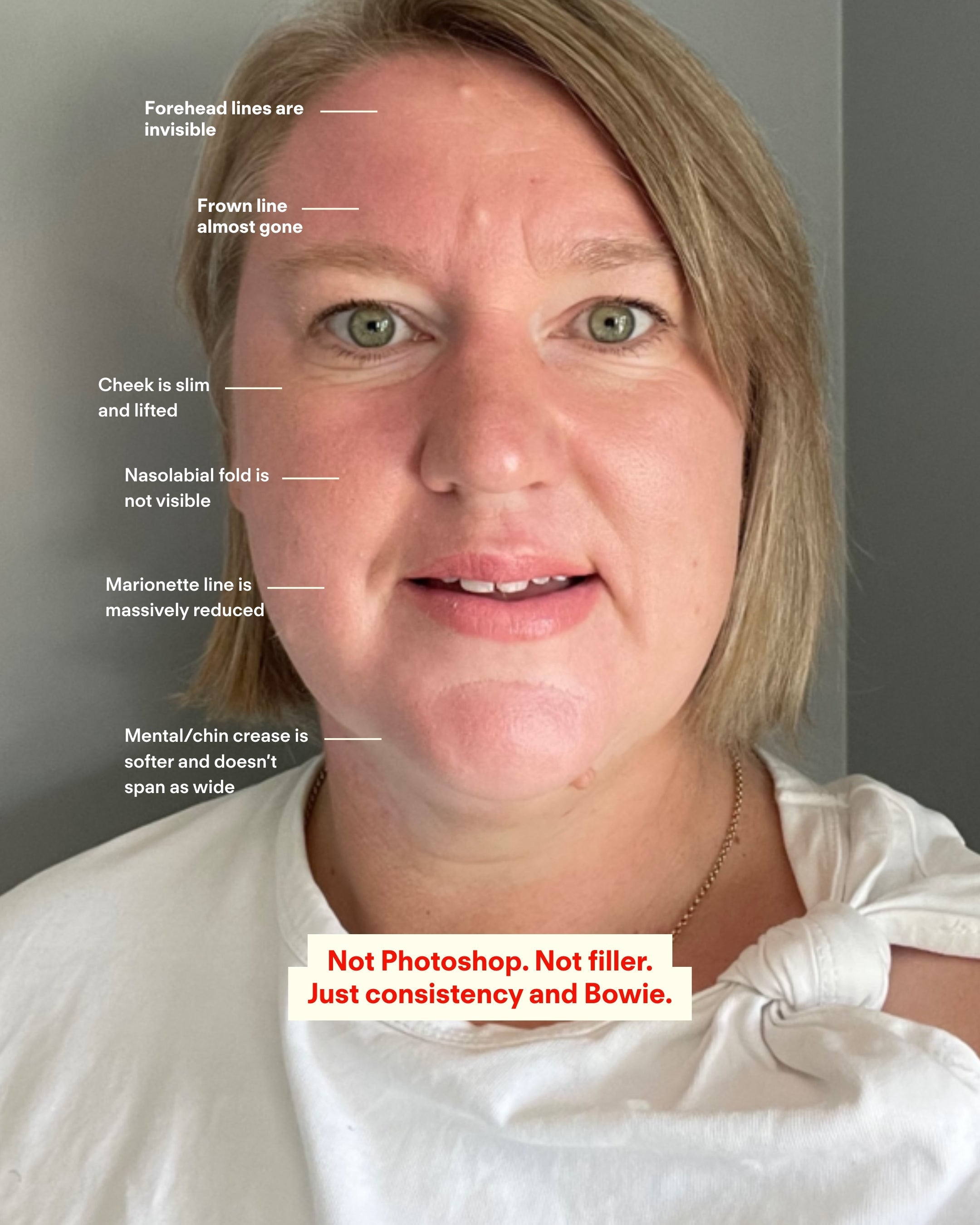 Our customer microneedled one side of her face.