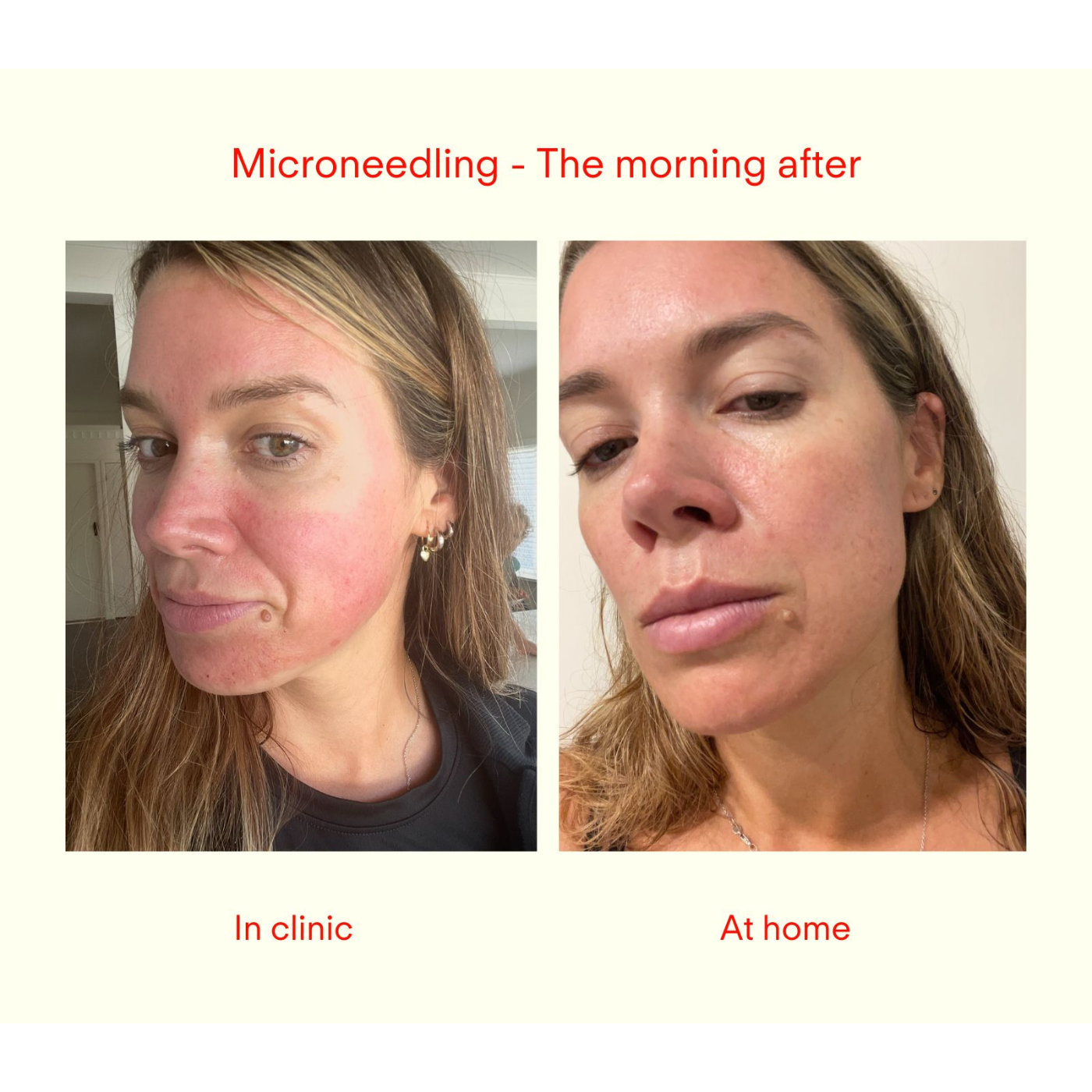 Microneedling: In clinic vs. at home. Here's what you need to know.