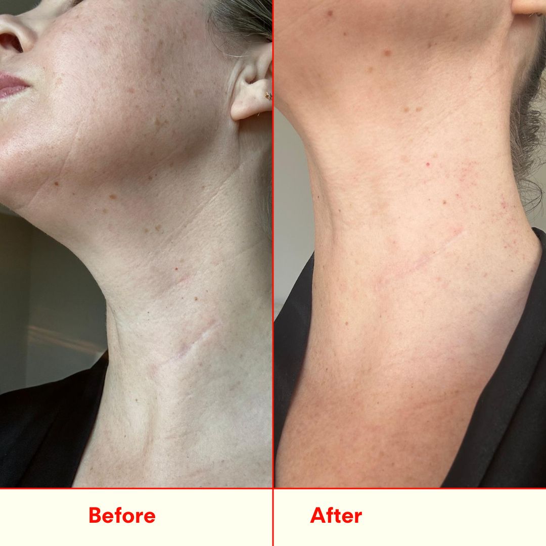 Before and after neck and jawline comparison