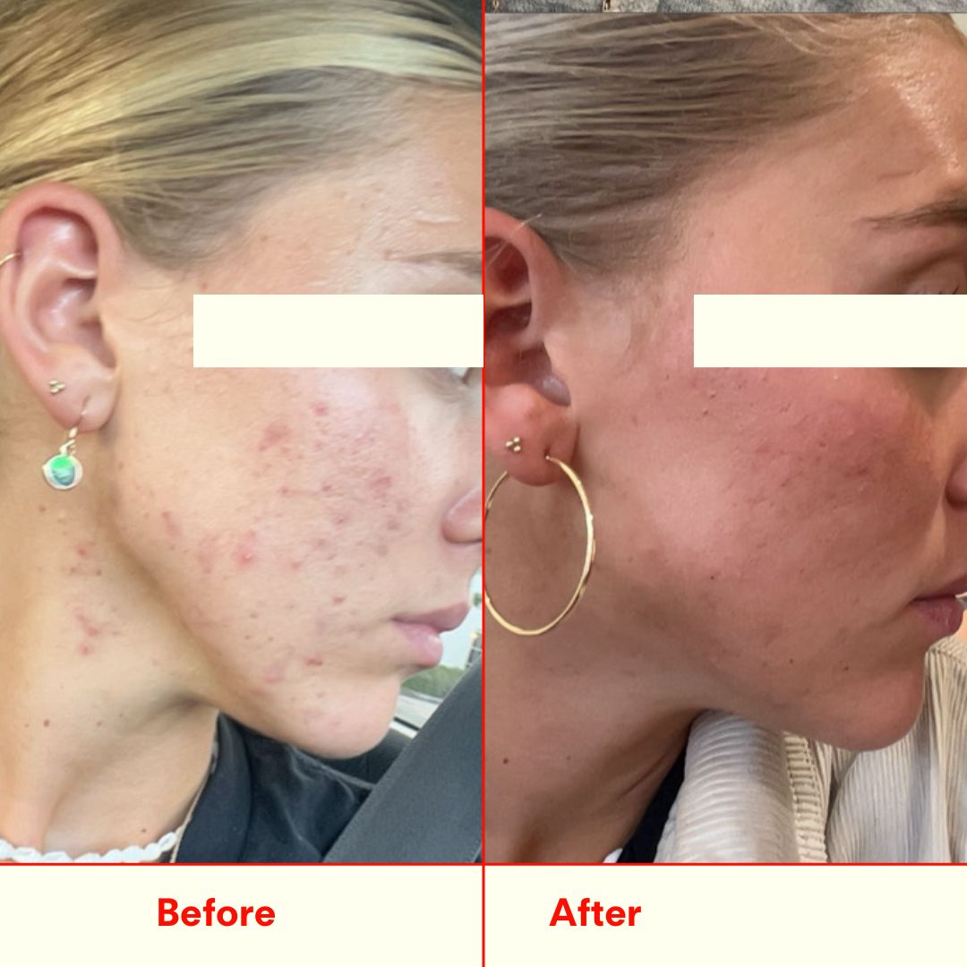 Before and after cheek comparison