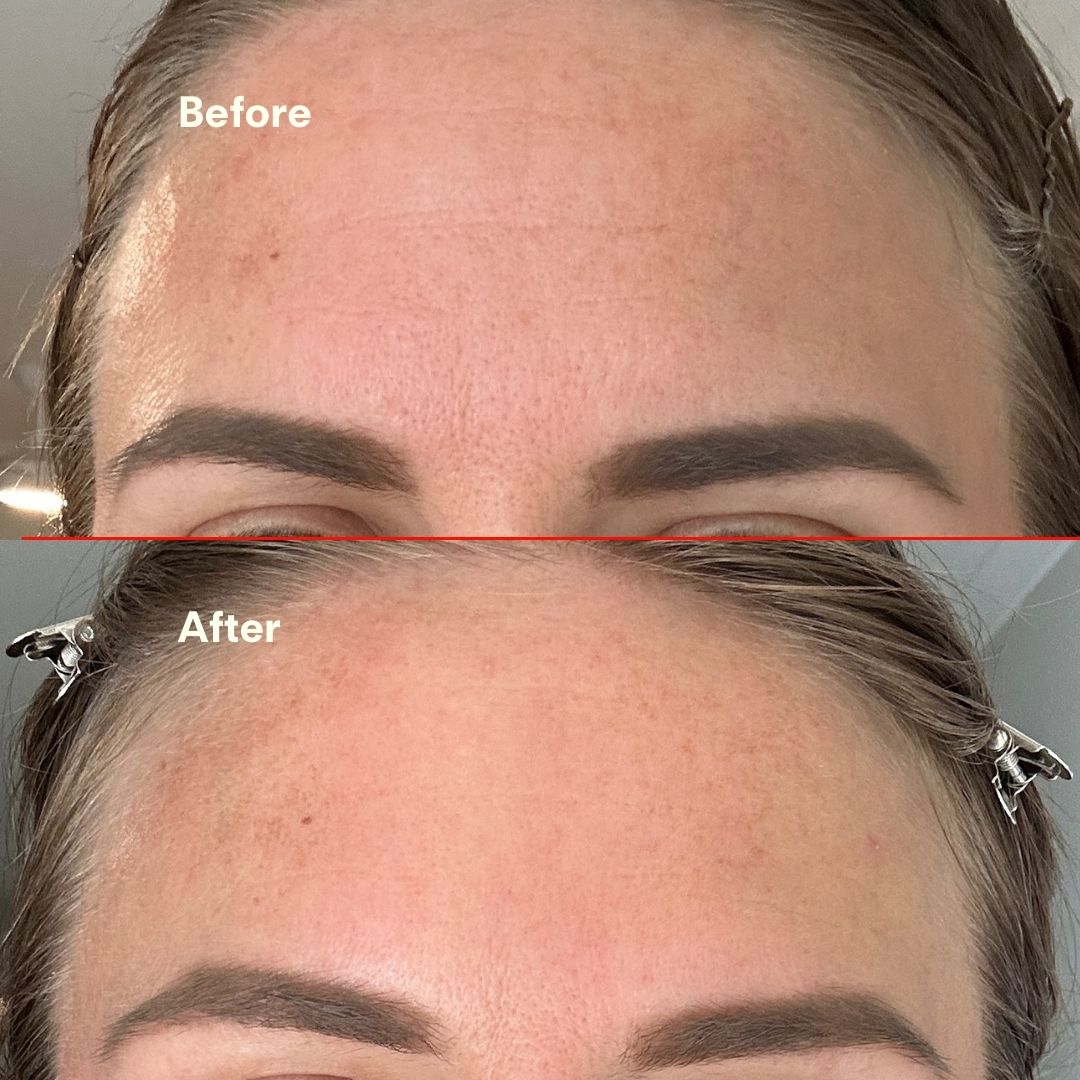 Before and after forehead comparison