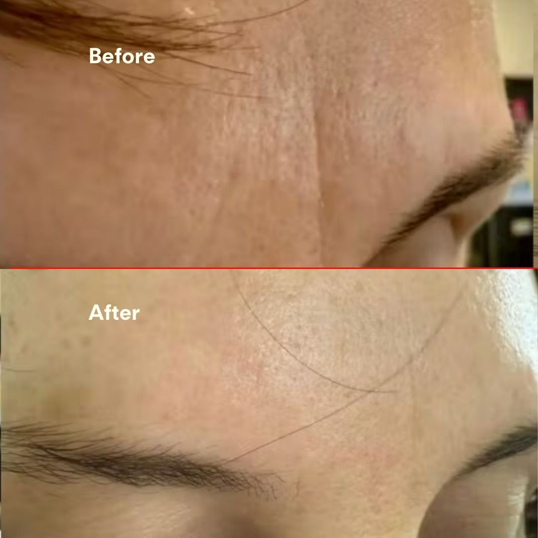 Before and after forehead close-up