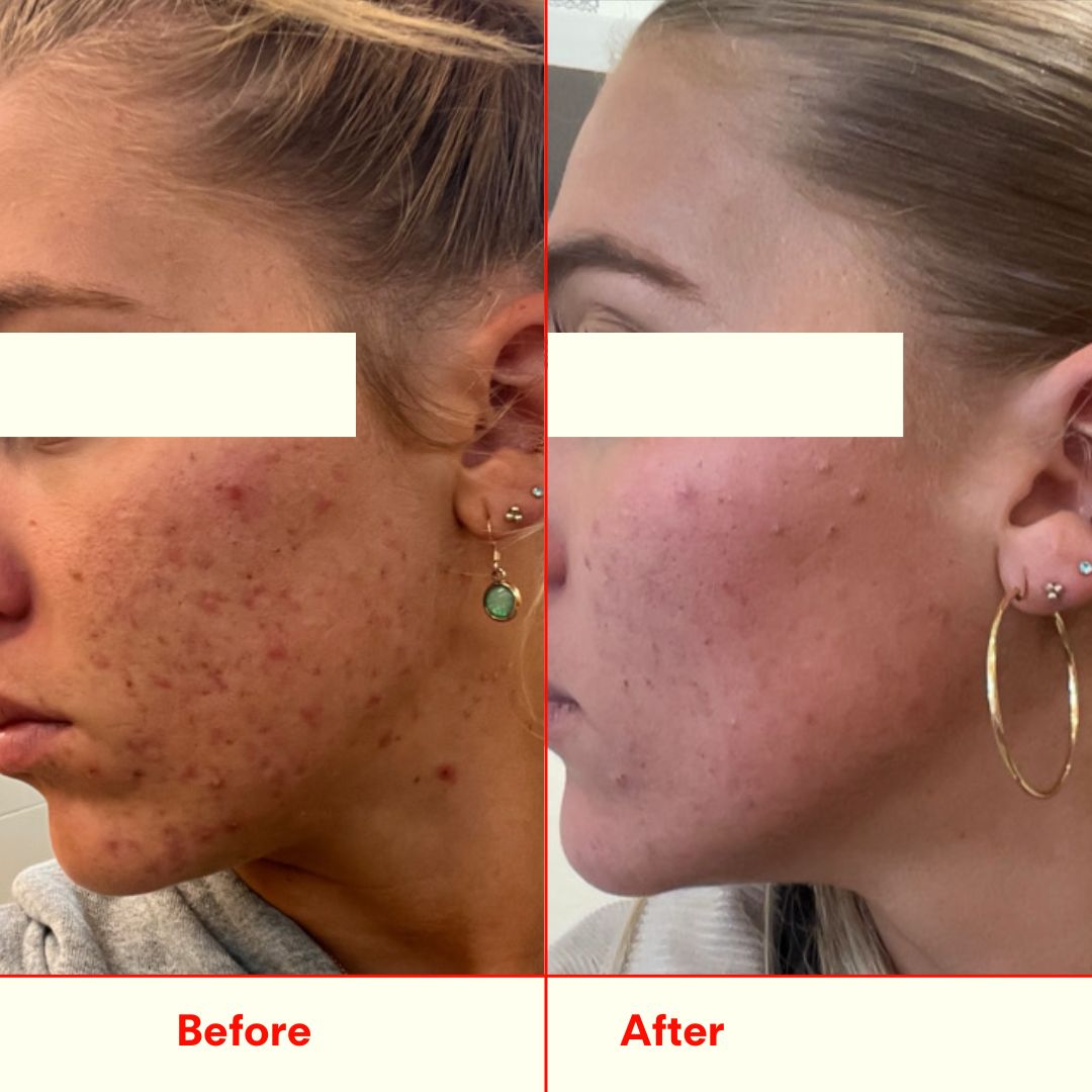 Before and after cheek comparison, alternate view
